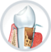 Удаление зуба воспалении десен в Купчино